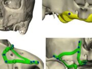 La cirurgia oral avança amb implants subperiòstics dissenyats amb tecnologia CAD/CAM